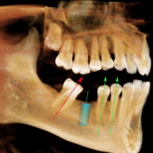 челюсть пациента с наклонившимся жевательным зубом и с 3д-моделью импланта