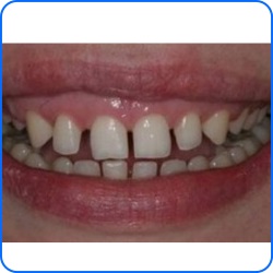 Промежутки между зубами