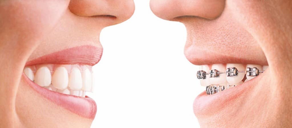 aligners-vs-braces